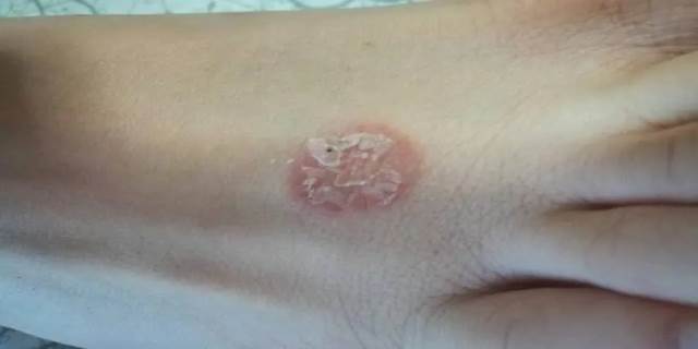 猫藓传染人的几率大不大