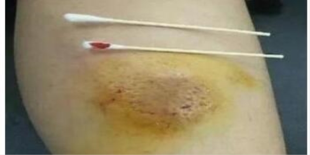 怎么能判断伤口是狗咬的